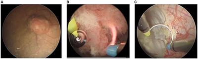 Automated surgical step recognition in transurethral bladder tumor resection using artificial intelligence: transfer learning across surgical modalities